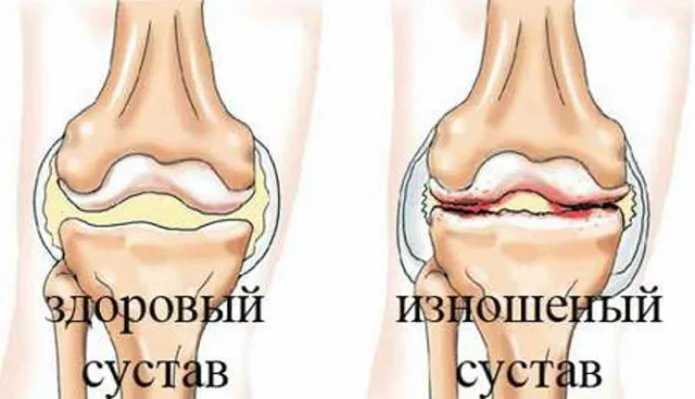 Кости изнутри при артрозе