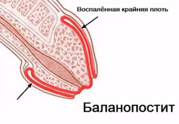 При баланопостите воспаление начинает исходить от головки препуция и слизистой крайней плоти