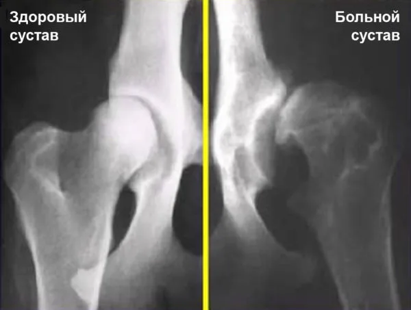Дисплазия тазобедренного сустава: снимок здорового и больного фрагмента