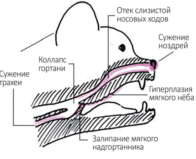Благодаря хирургическому вмешательству мягкое небо перестанет быть преградой при дыхании