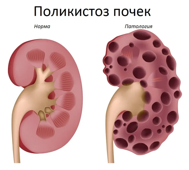 Здоровая и больная почка