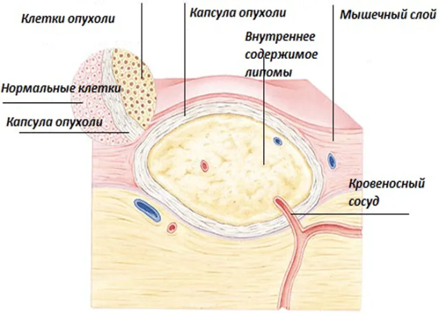 Липома изнутри
