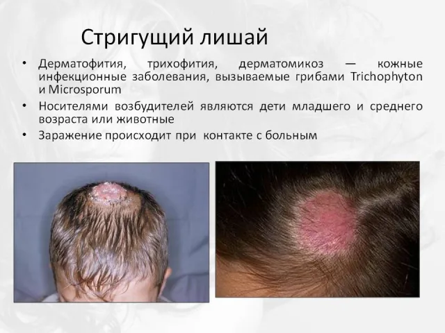 Стригущий лишай