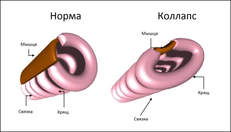 Схематическое изображение коллапса трахеи