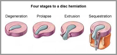 Четыре стадии разрушения межпозвонкового диска