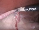 Лапароскопический метод стерилизации