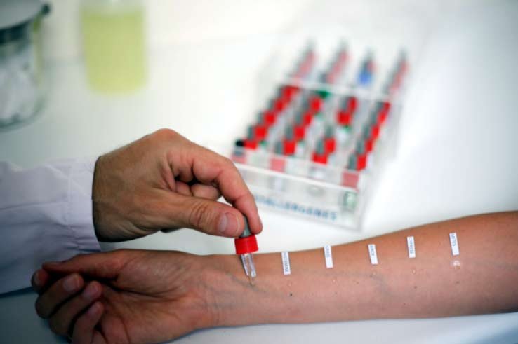 Самый распространенный тест на аллергию - кожный, но кому-то он может быть противопоказан