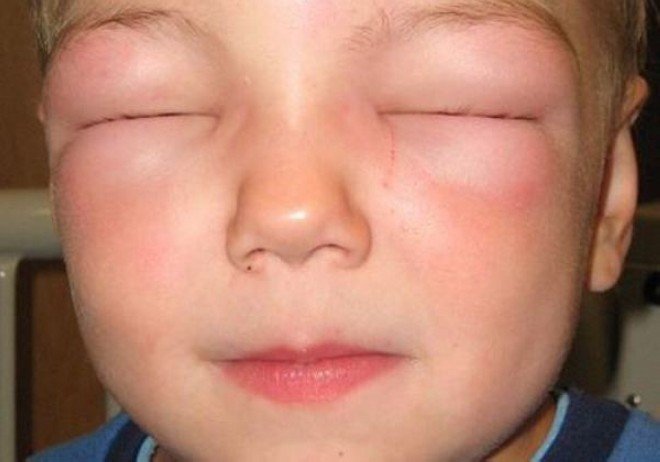 Отек Квинке — смертельно опасная реакция организма на аллерген