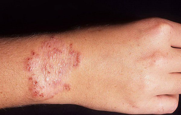 Пятна на коже при дерматомикозе