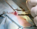 Стерилизация через сверхмалый разрез при помощи хирургического крючка