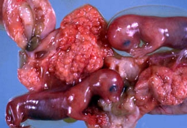 Если выкидыш все-таки произошел, важно сохранить эмбрионов и передать их врачу для анализов