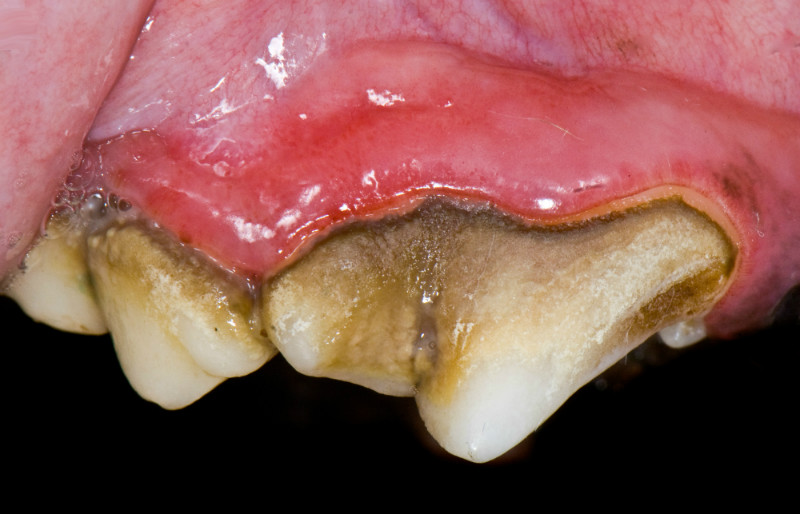 Наддесневый зубной камень легче поддается удалению с зуба